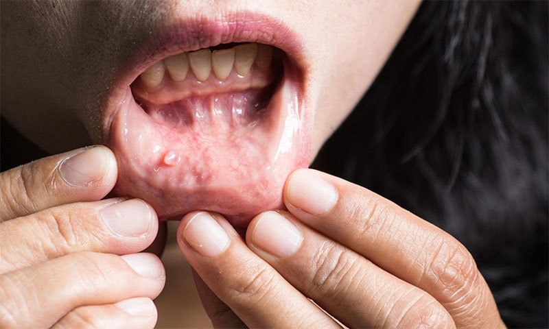 منہ میں کینسر کی یہ خاموش علامات جانتے ہیں؟
