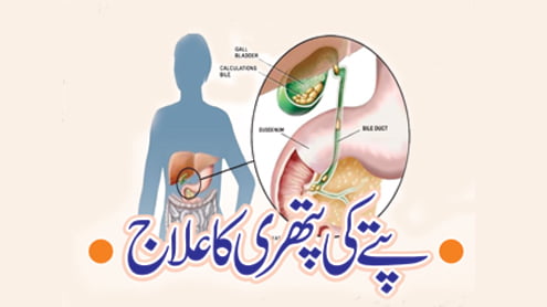 پتے میں پتھری