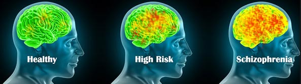 schizophrenia شیزو فرینیا