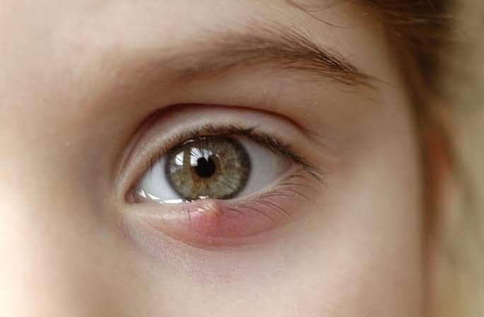 آنکھ کی سٹائی Eye stye