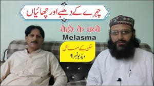 Read more about the article چہرے کی چھائیاں  ► Skin problems & diseases