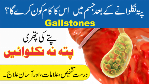 پتے کی پتھری ● पित्ताशय की थैली की पथरी 2 Facebook Nukta پتے کی پتھری gallstones 2