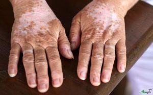 Read more about the article پھلبہری(سفید داغ)