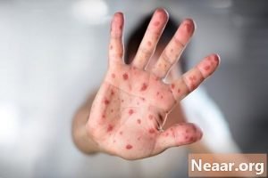 Read more about the article ہاتھ اور پاٶں کی تشخیصی علامات