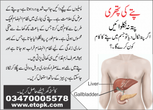 gallbladder stone پتے کی پتھری 2 gallbladder stone پتے کی پتھری 2