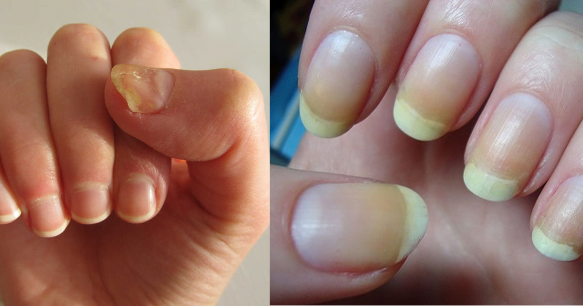 ناخن کا رنگ اور بیماریاں شوگر 1