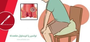 Read more about the article بھگندر یا نواسیر