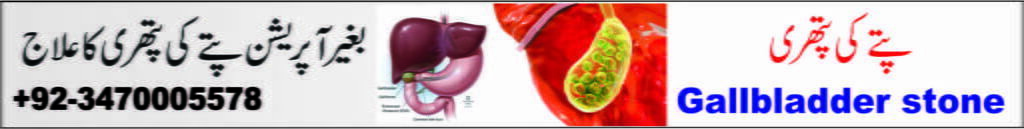 Gallbladder stone پتے کی پتھری 7