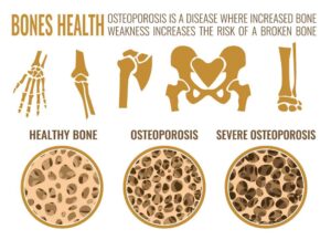 5 Osteoporosis Tongkat Ali 11