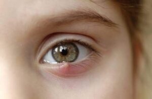 Read more about the article آنکھ کی سٹائی Eye stye