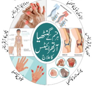 Read more about the article آرتھرائیٹس