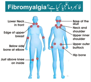 Read more about the article فائبرومائلجیا